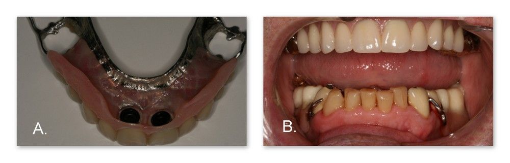 A before and after picture of a person's teeth.