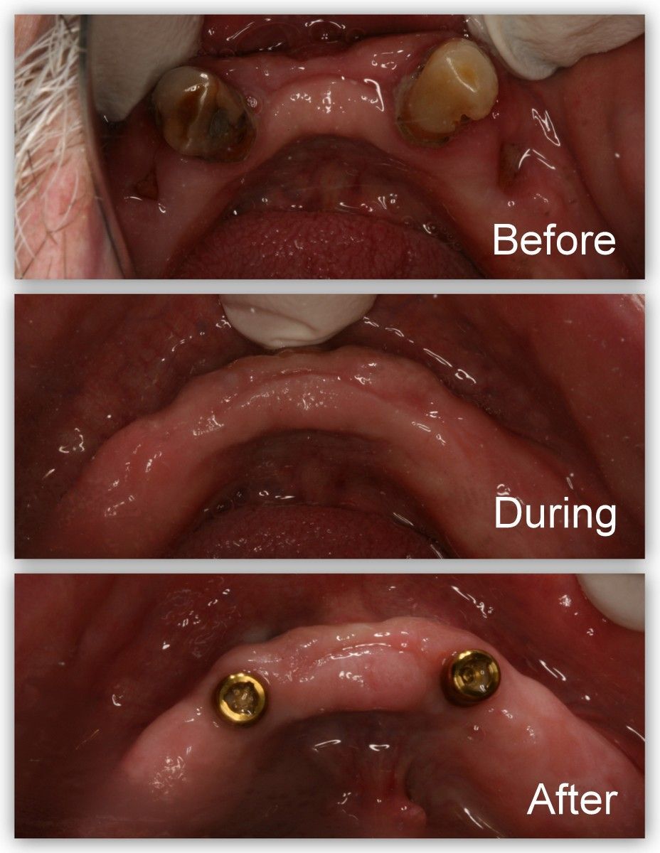 Pictures of a dental patient's mouth before, during and after receiving an overdenture.