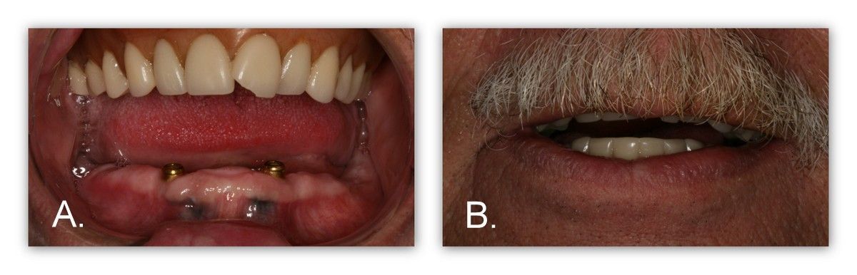 Before and after pictures of a dental patient's mouth