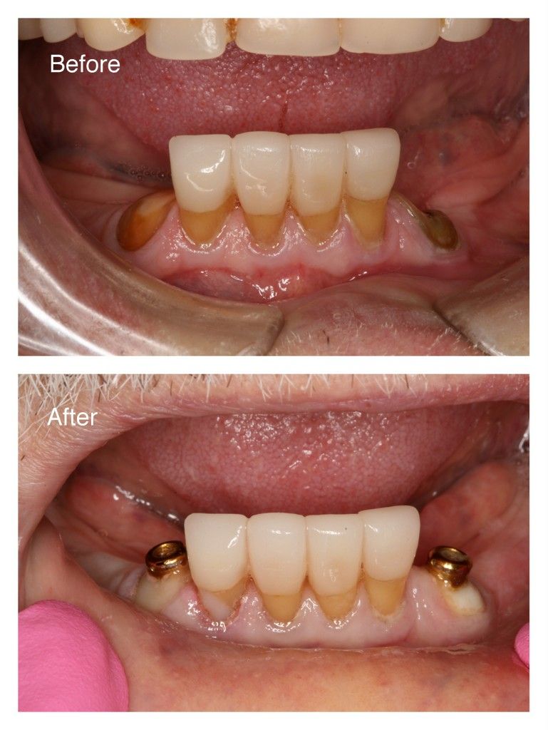 Before and after pictures of a dental patient's mouth