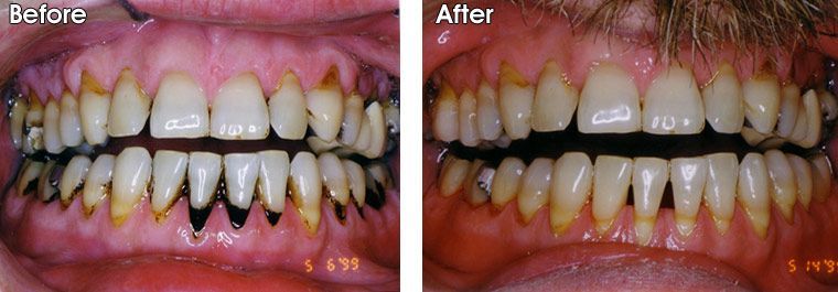 A before and after photo of a person 's teeth