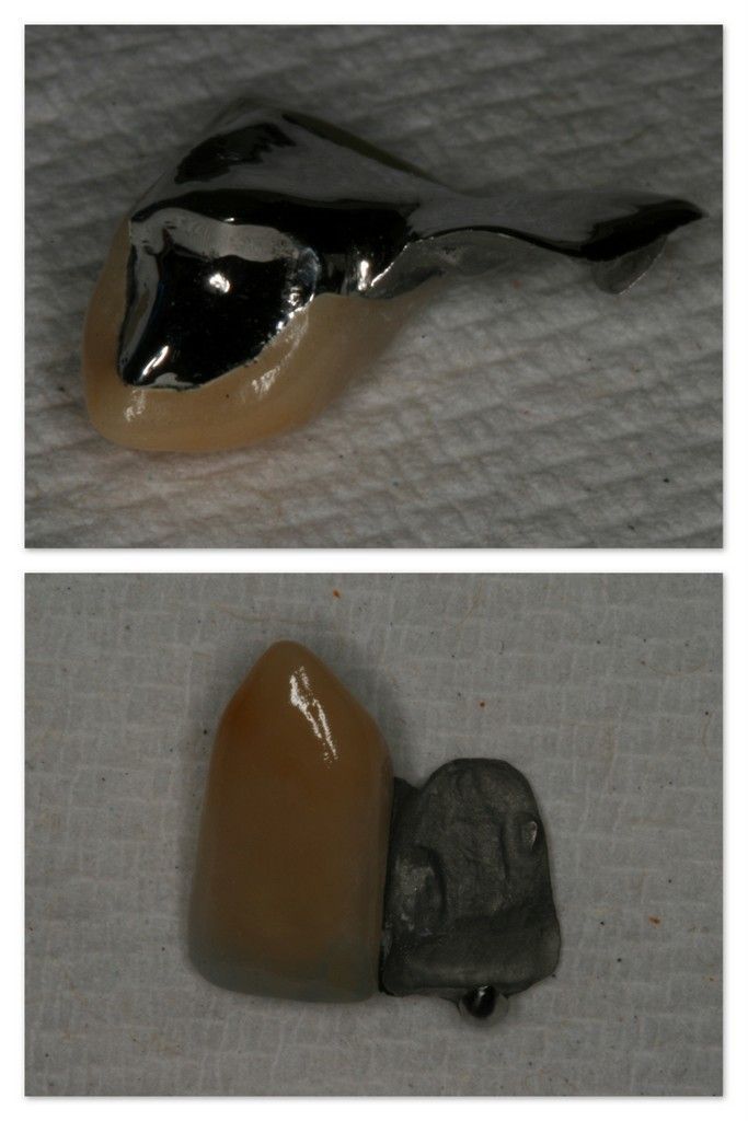 Two pictures of a tooth with a metal crown on it.