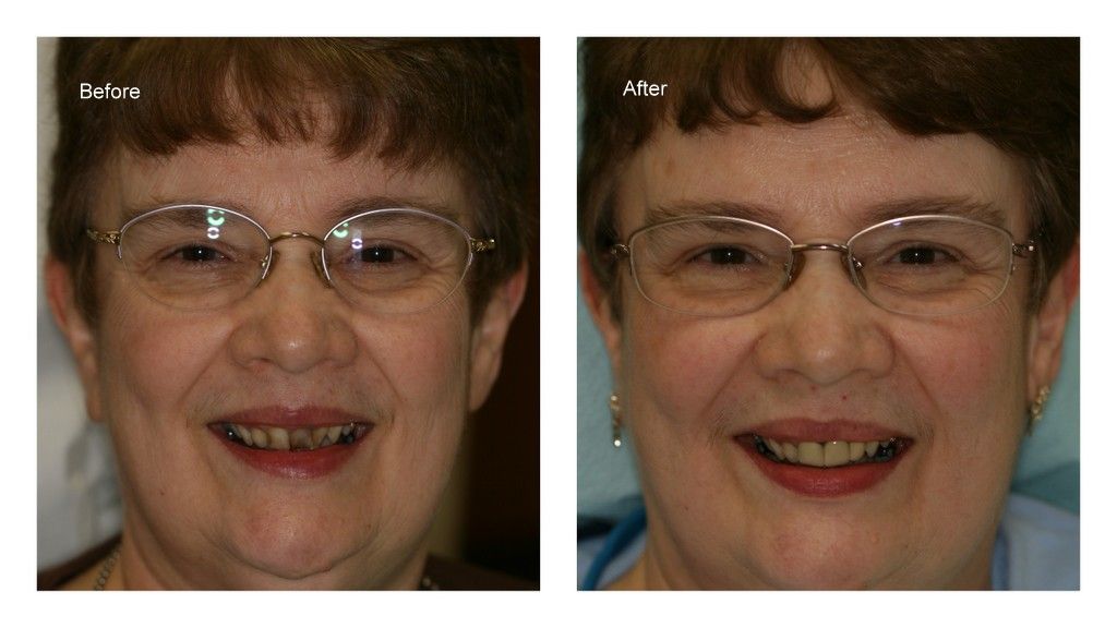 A before and after photo of a woman wearing glasses and smiling.