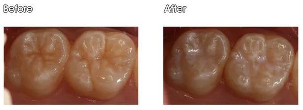 A before and after picture of a person's teeth.