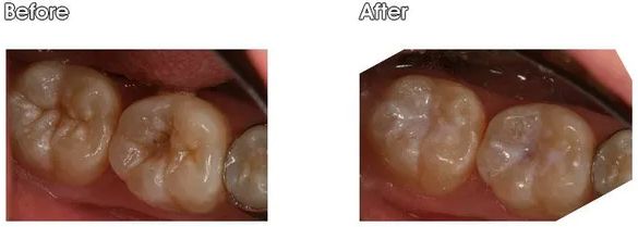 A before and after picture of a person's teeth.