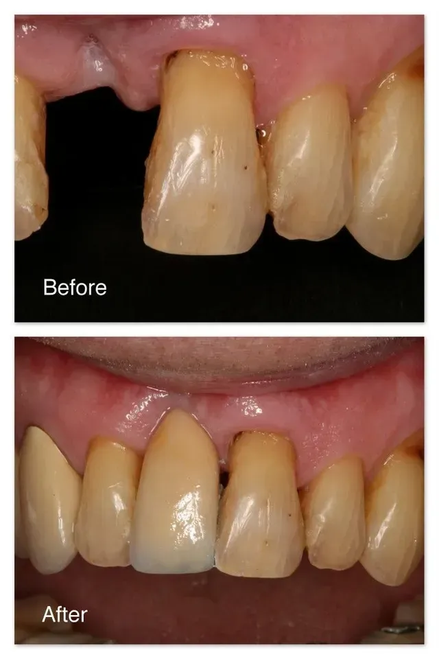 A before and after picture of a person's teeth.