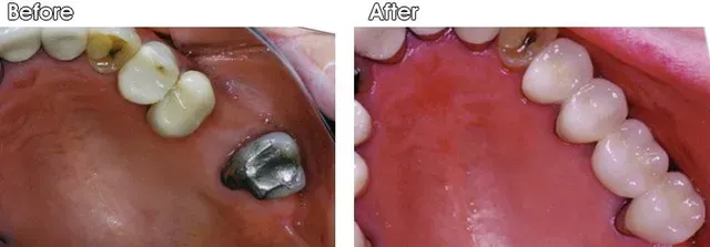 A before and after picture of a person's teeth.