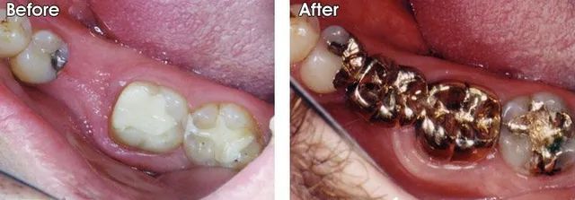 A before and after picture of a person's teeth.