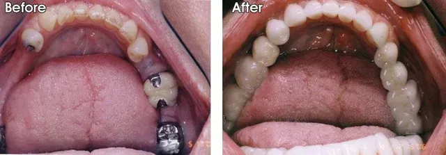 A before and after picture of a person's teeth.