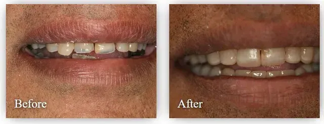 A before and after picture of a man's teeth.