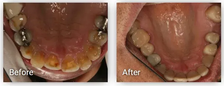 A before and after picture of a person's teeth.