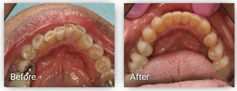 A before and after picture of a person's teeth
