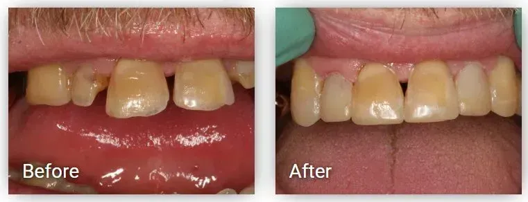 A before and after picture of a person's teeth.