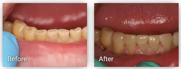 A before and after picture of a person's teeth.