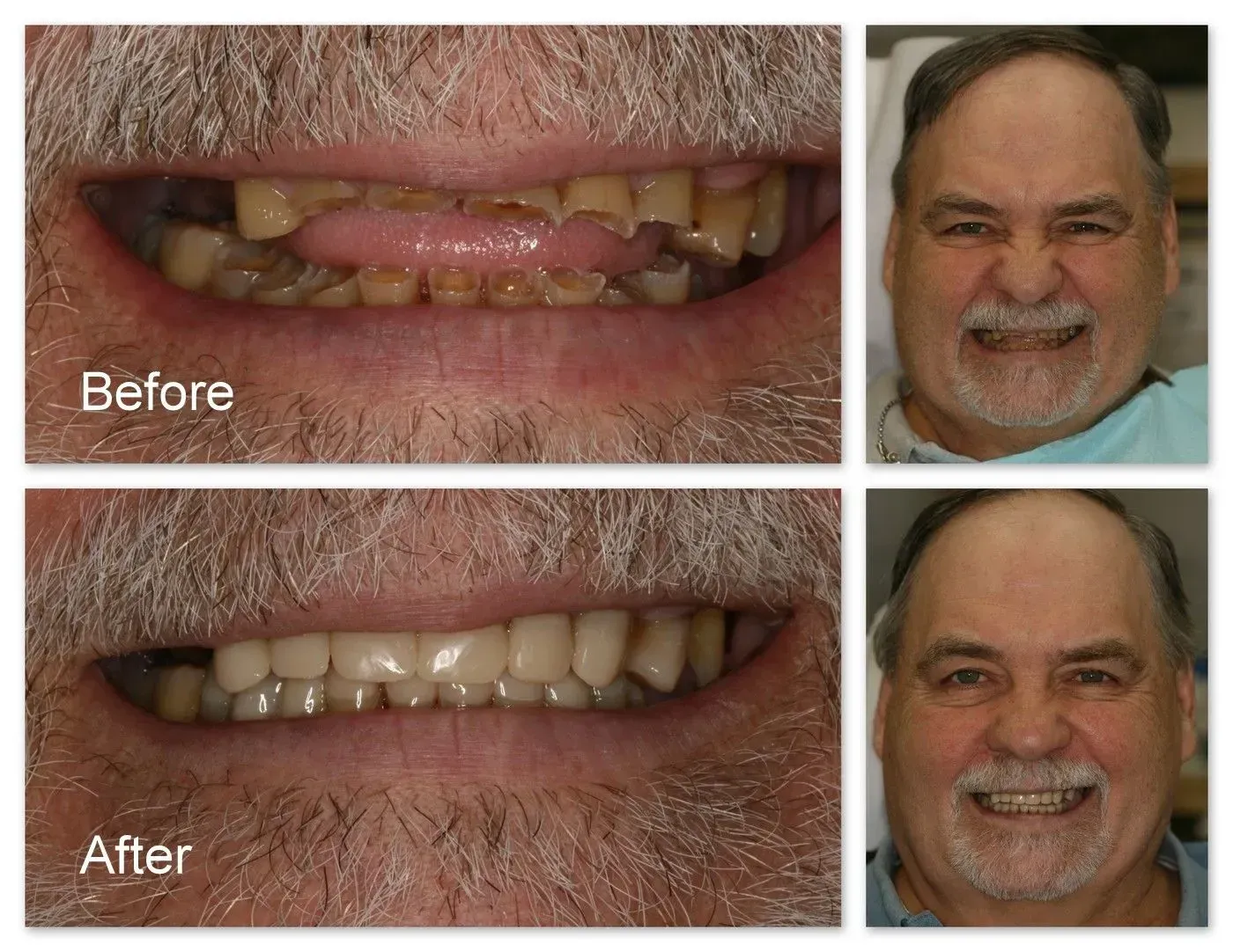 A before and after photo of a man's teeth.