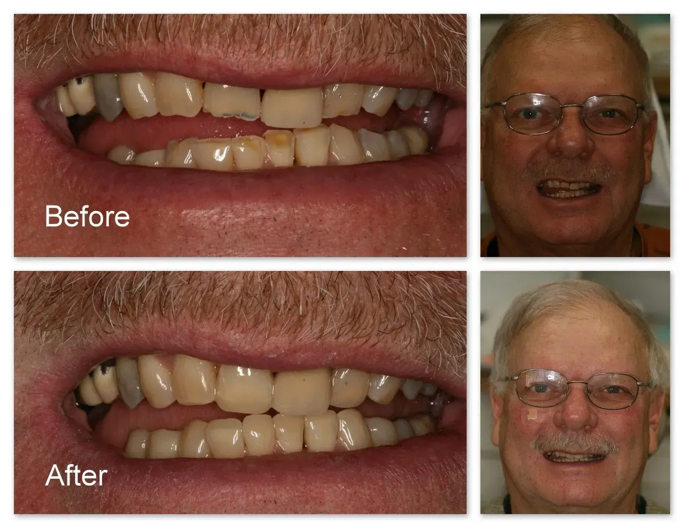 A before and after picture of a man's teeth.