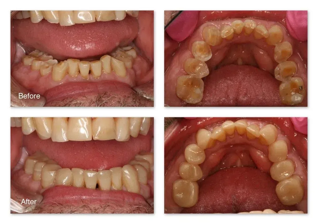 A before and after picture of a person's teeth.