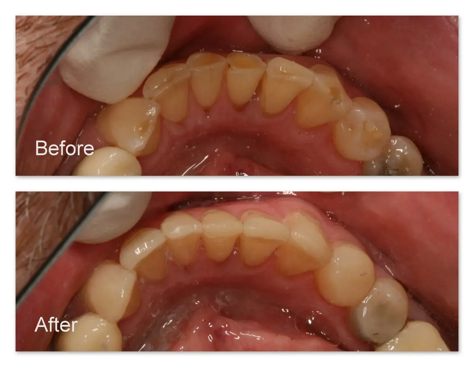 A before and after picture of a person's teeth.