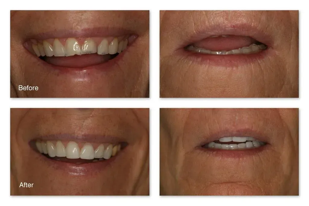 A before and after picture of a woman's smile.