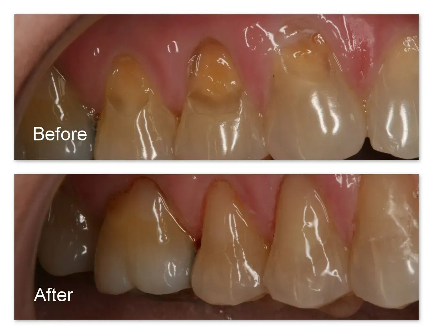 A before and after picture of a person's teeth.