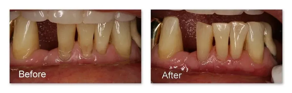 A before and after picture of a person's teeth.