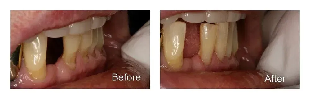 A before and after picture of a person's teeth.
