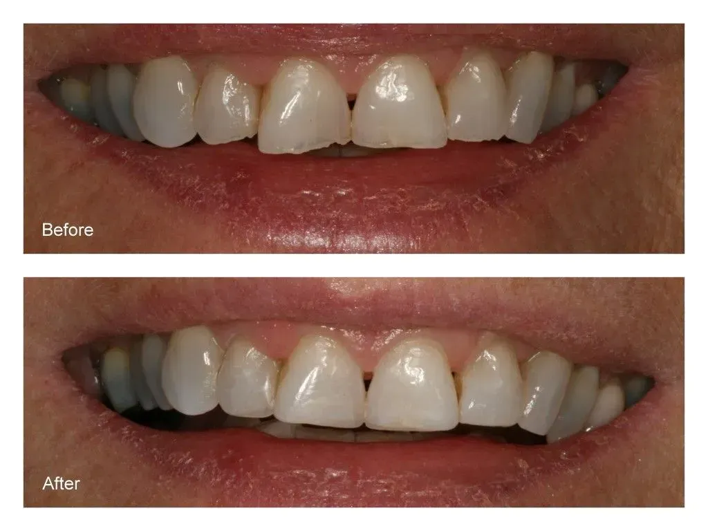 A before and after picture of a person's teeth.