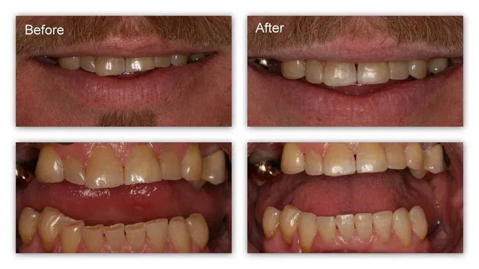 A before and after picture of a man's teeth.