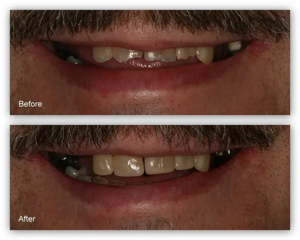 A before and after picture of a man's teeth.