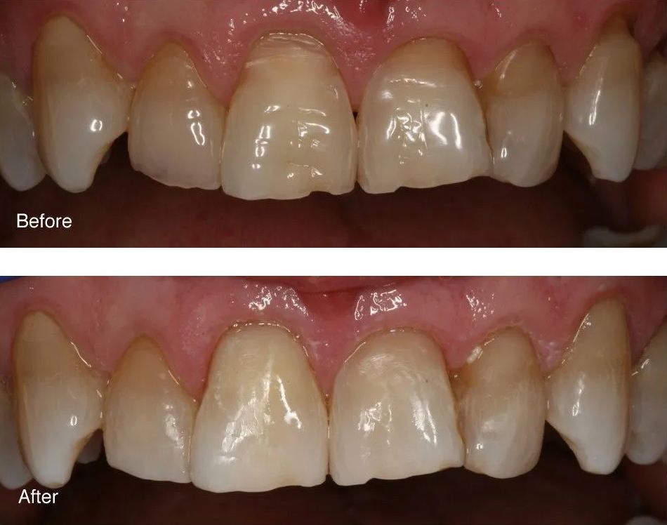 A before and after picture of a person's teeth.