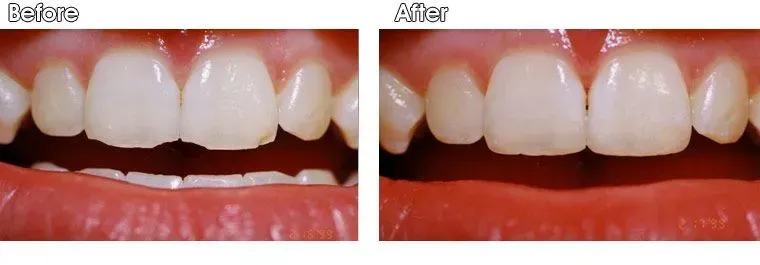 A before and after picture of a person's teeth.