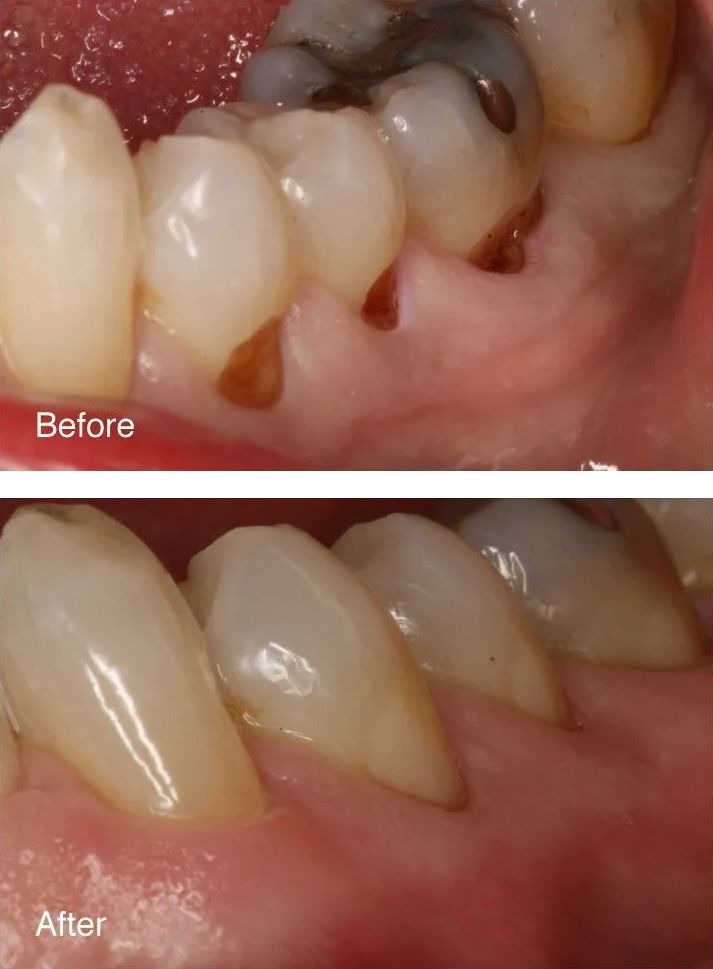 A before and after picture of a person's teeth.