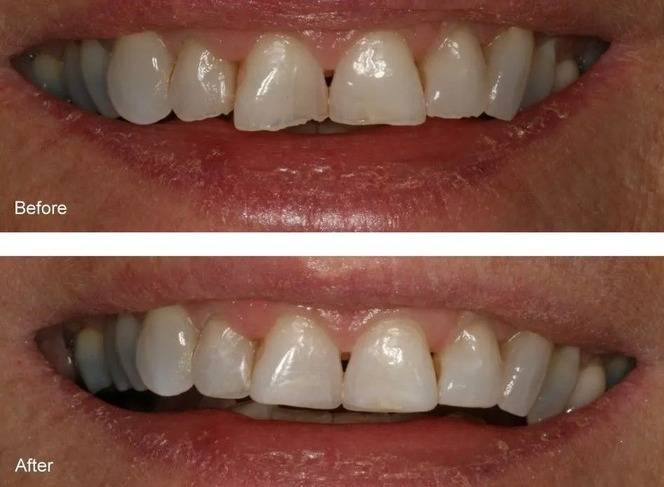 A before and after picture of a person's teeth.