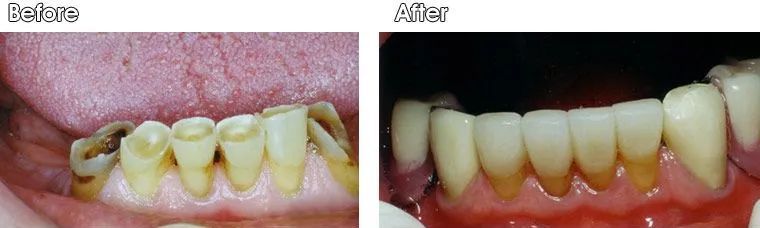 A before and after picture of a person's teeth.