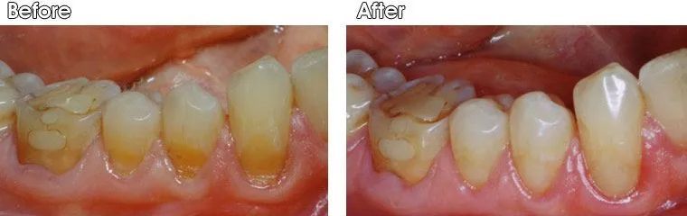 A before and after picture of a person's teeth.