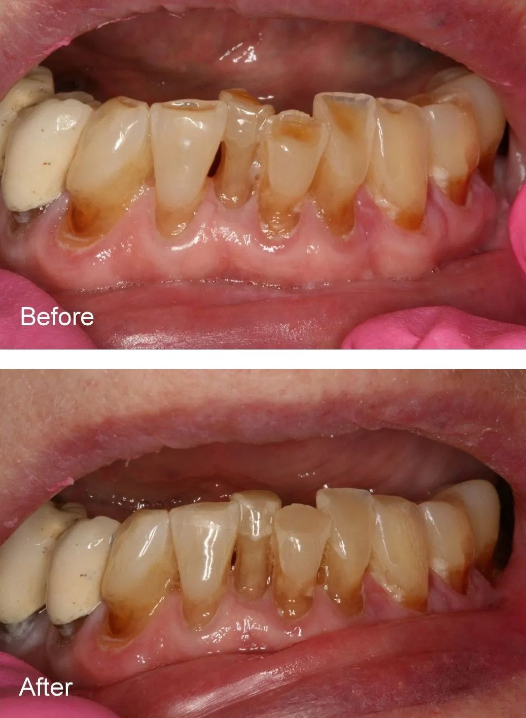 A before and after picture of a person's teeth.