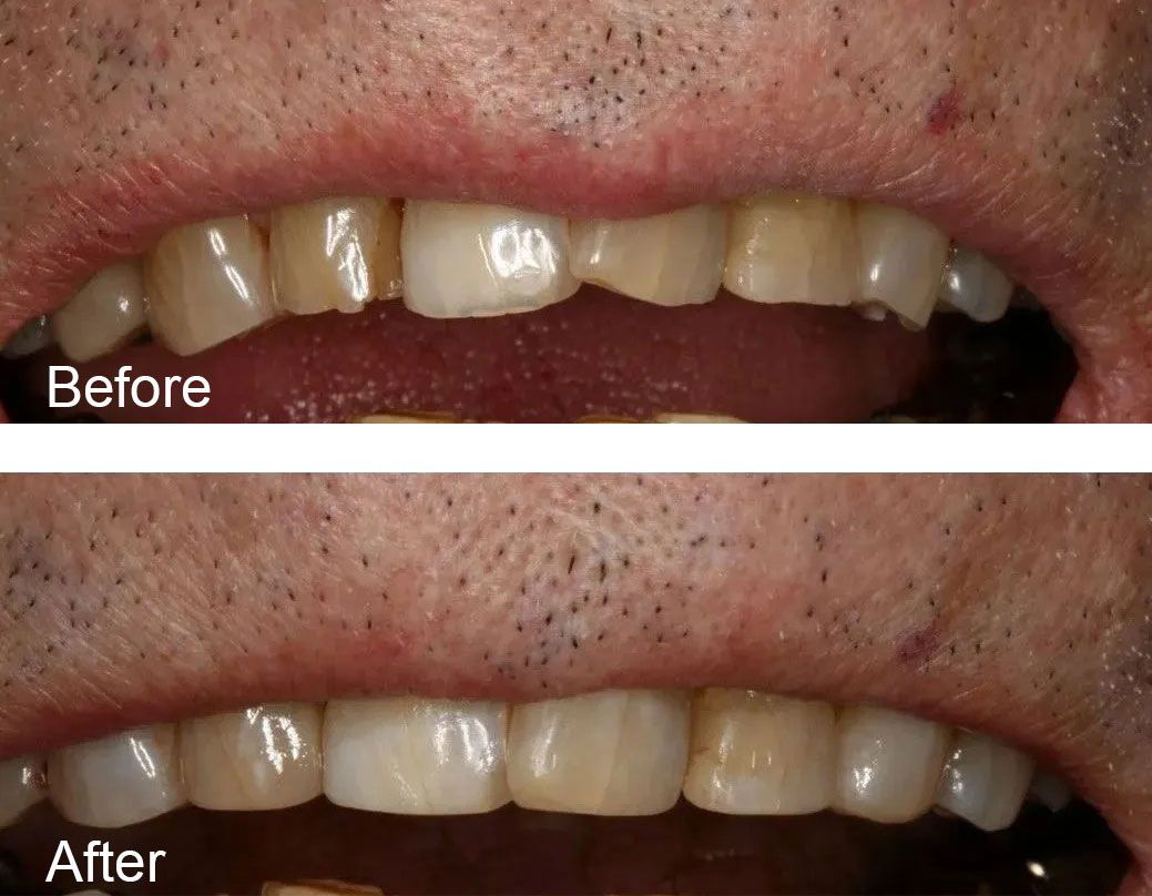 A before and after picture of a man's top teeth.