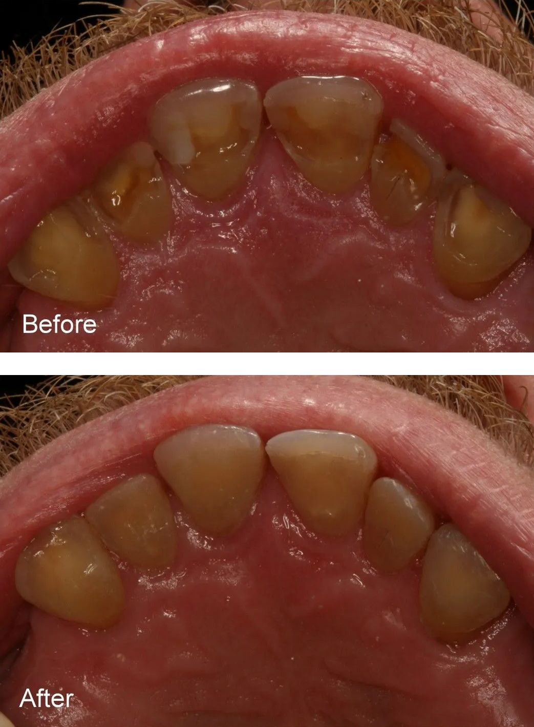 A before and after picture of a person's teeth.