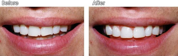A before and after picture of a woman's teeth.