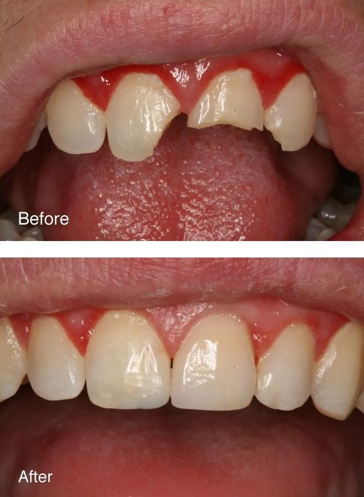 A before and after picture of a person's teeth.