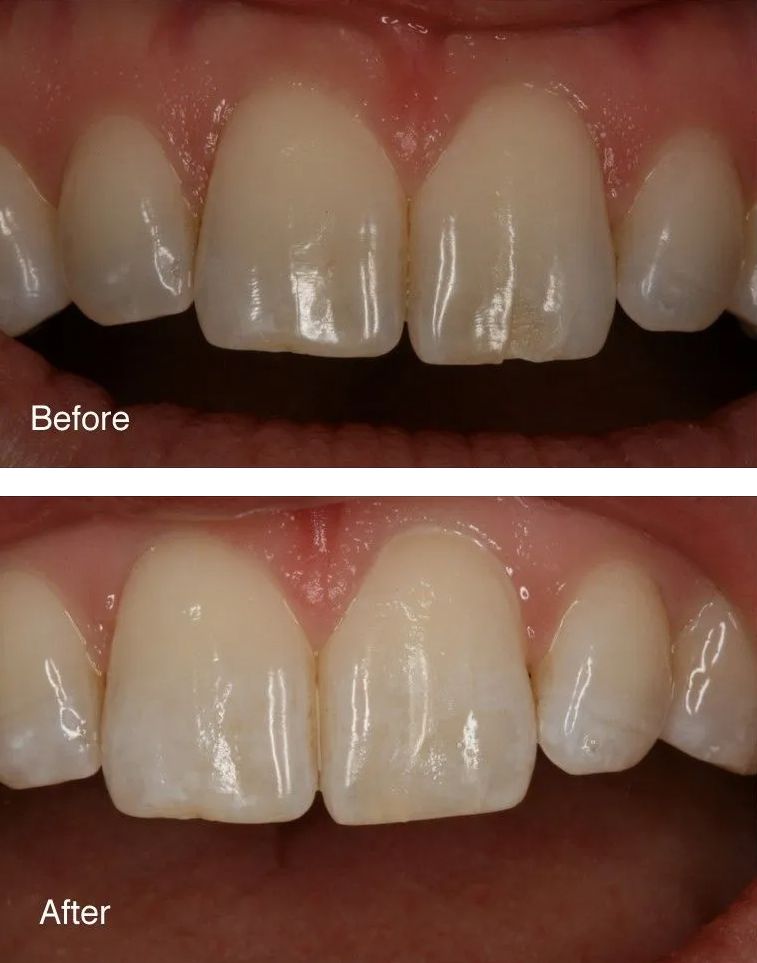 A before and after picture of a person's teeth.