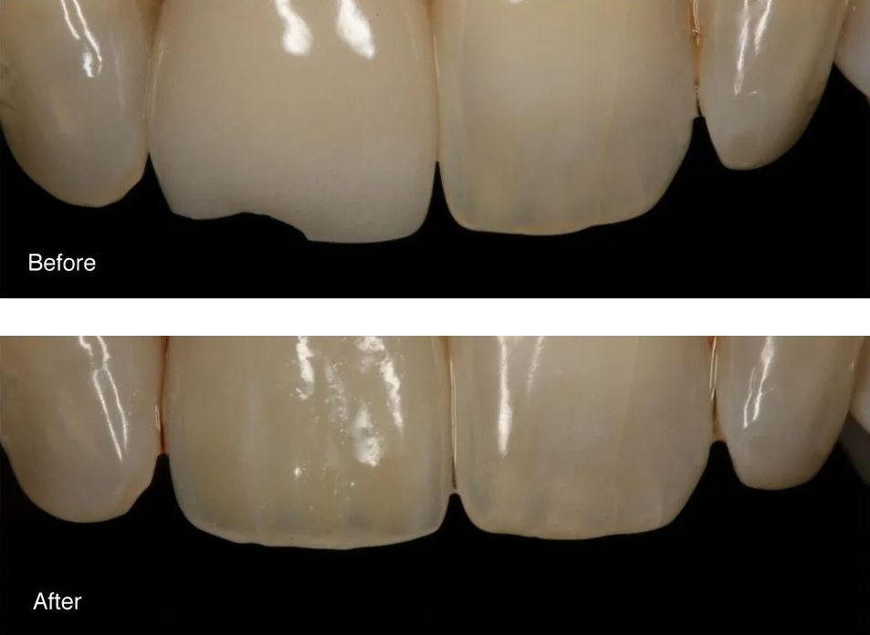 A before and after picture of a person's teeth.