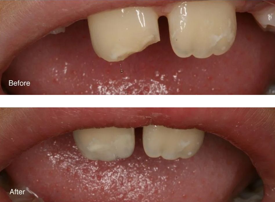 A before and after picture of a person's teeth.