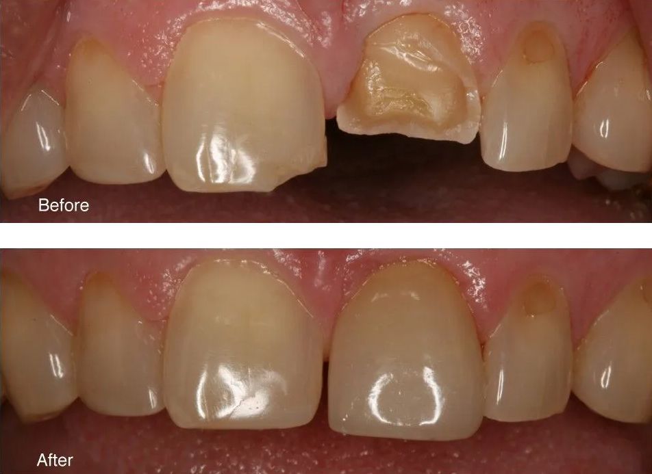 A before and after picture of a person's teeth