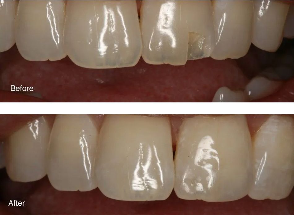A before and after picture of a person's teeth.