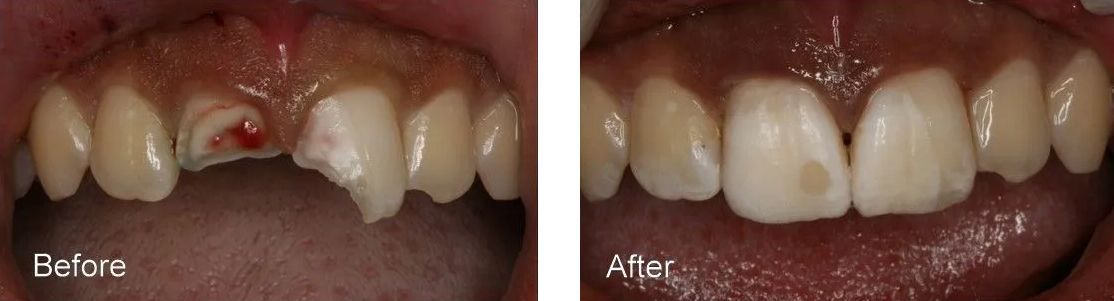 A before and after picture of a person's teeth.