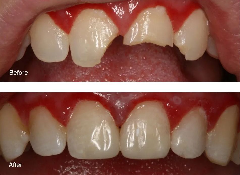 A before and after picture of a person's teeth