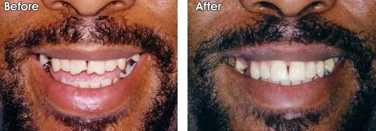 A before and after picture of a man's teeth.