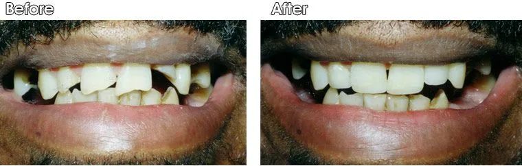 A before and after picture of a man's teeth.