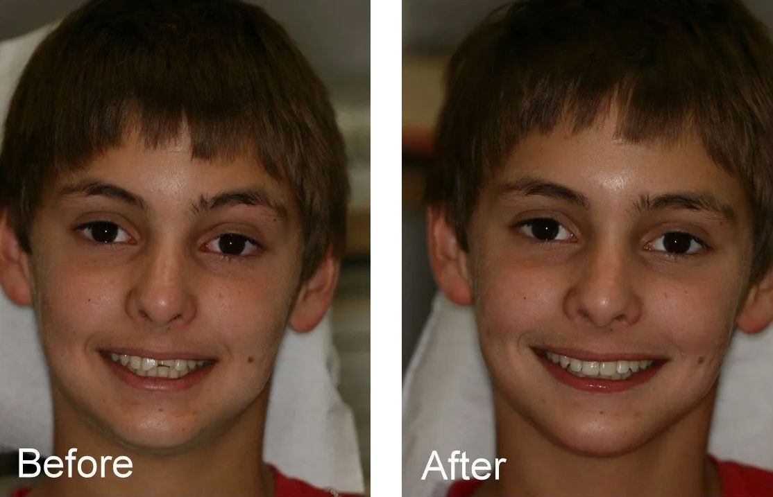 A before and after picture of a young boy's face.